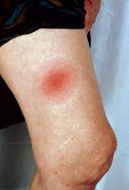 Lyme Disease Infectious Diseases Msd Manual Professional Edition