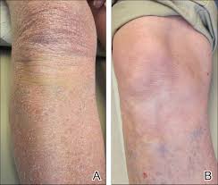 3 425 просмотров • 21 мая 2020 г. Pityriasis Rubra Pilaris And Severe Hypereosinophilia Mdedge Dermatology