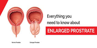 Here are 10 more facts about prostate cancer. Everything You Need To Know About Enlarged Prostate Rg Hospitals