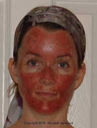 These differences mean that anti metabolites stop cancer cells working properly. Fluorouracil Healthy Tan Treatment Photo