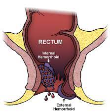 First degree is characterized by the hemorrhoidal. Hemorrhoids Expanded Version Ascrs