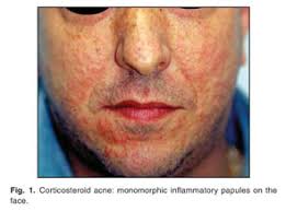 Chloracne is the only overt clinical sign of dioxin exposure in humans. Drug Induced Acneiform Eruption Document Gale Onefile Health And Medicine