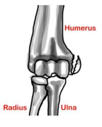 The epicondyle is one factor similar to the condyle nevertheless is present on the outer flooring on excessive of the condyle, it would not have. Elbow Injuries Epicondyle Fracture Medial Em Ortho Grepmed