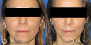 Cheek & Chin Implants