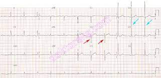 Histopathology of (a) normal myocardium and (b) myocardial hypertrophy. Left Ventricular Hypertrophy Increased Left Ventricular Wall Thickness Sol Ventrikul Hipertrofisi Lvh Increased Left Ventricular Wall Thickness Linke Ventrikulare Hypertrophie Ekg Ecg Ankara Kardiyoloji Kalp Hastaliklari Mete