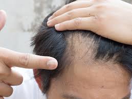 One warning—make sure you wash the towel immediately, unless you want it to smell like onions. The 5 Suprising Remedies That Stop Hair Loss Naturally