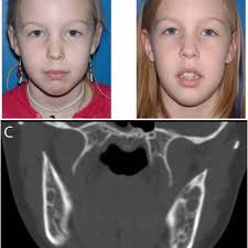 Tomography in a 41 years old woman of china origin diagnosed with cherubism shows a remarkable expansion of the mandible, which can. Pdf Cherubism Best Clinical Practice