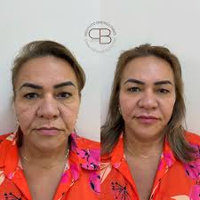 Primeira etapa do protocolo de rejuvenescimento com harmonização facial!  Cada detalhe é planejado para conquistar resultados sutis, naturais e  progressivos, respeitando a individualidade de cada paciente. 💖 E se você  deseja dar
