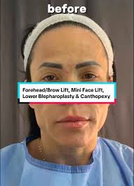 Mini Facelift and Brow Lift Before-and-After Transformation