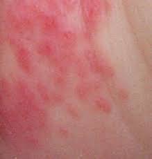 Image result for diaper dermatitis
