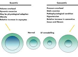 Image result for Left Ventricular Hypertrophy