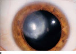 Herpes simplex virus (hsv) stromal keratitis and endotheliitis. Corneal Infections Inflammations And Surface Disorders Ento Key