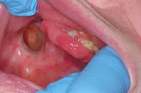 The areas to which cells have spread vary according to the type of oral cancer. Dental Treatment Planning For The Patient With Oral Cancer Dental Clinics
