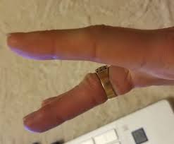 Image result for Ring Removal