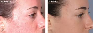 DiamondGlow Facial Newport Beach