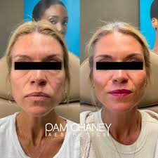 Sculptra and Radiesse Combination for Natural Collagen Growth