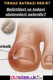 Tirnak Batmasi Nasil Gecer Tedavi Yontemleri Cilt Guzellik Tirnak Batmasi Dogal Cilt Bakimi Tirnak