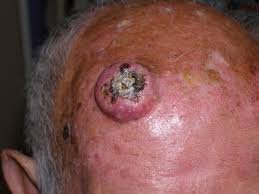 Tumor frontal
