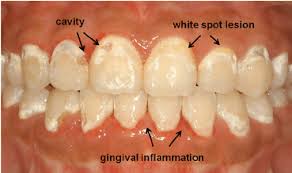 Help learn how to tell the differences between a cavity and sensitive teeth. Q A Braces For Children Big Tooth Little Tooth Blog