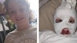 Urangan's Daniella Jacobs-Herd suffered severe burns after a backyard fire  incident