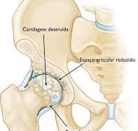 Artroplastia total de quadril (Total Hip Replacement ...