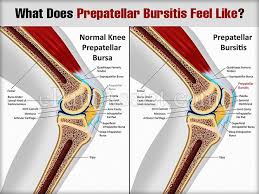What Does Prepatellar Bursitis Feel Like Prepatellar Bursitis Bursitis Bursitis Knee