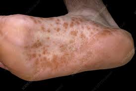 Image result for dyshidrosis