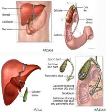 Image result for Choledocholithiasis