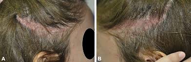 When a person has lichen planopilaris it will usually present itself as smooth areas hair loss from your scalp that is white. Lichen Planopilaris With Koebner Phenomenon Jaad Case Reports