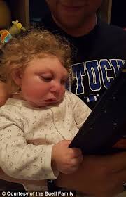 Toddler with brain malformation outlives expectations