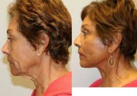 Dr Jill Hessler, MD, Palo Alto, California (94306) Mrs. Treated With Neck  Lift Candidate » Eyelid Surgery: Cost, Photos, Rewiews, Q&A