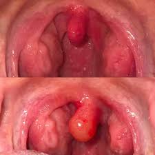 Mandelentzündung » eine mandelentzündung (angina tonsillaris) ist meistens eine begleiterscheinung einer allgemeinen erkältung. Kann Eine Eitrige Mandelentzundung Alleine Heilen Achtung Foto Gesundheit Und Medizin