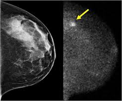 Breast cancer and some noncancerous (benign) breast conditions can appear white on a mammogram. Quandary With Mammograms Get A Screening Or Just Skip It The New York Times