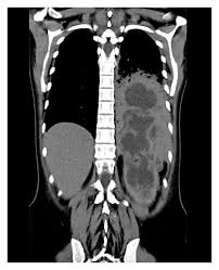 Image result for Perinephric Abscess