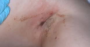 Image result for sore skin in the groin area
