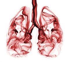 Pulmonary embolism (pe) is a blockage of an artery in the lungs by a substance that has moved from elsewhere in the body through the bloodstream (embolism). Cuanto Tarda En Desaparecer Un Trombo En El Pulmon Trombo
