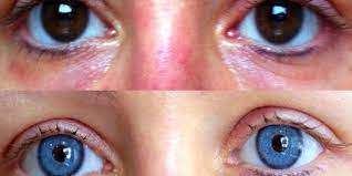siz sasirmis olmalisiniz goz rengi degistirme operasyonu hakkinda merak edilenler onedio com