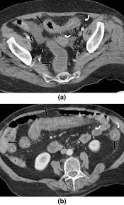 Image result for Neutropenic Colitis