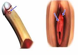 Setelah seseorang terinfeksi dengan sipilis, ada masa inkubasi, yakni masa sampai timbulnya gejala luka terbuka yang umum disebut chancre yakni sekitar 9 sampai 90 hari, dan biasanya pada 21 hari sudah dapat terlihat. Akibat Penyakit Sifilis Obat Sipilis Ok