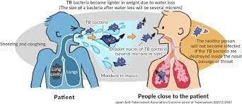 A type of bacteria called mycobacterium tuberculosis. Tuberculosis Transmission Routes And Unexpected Sources Of Infection Otsuka Pharmaceutical Co Ltd