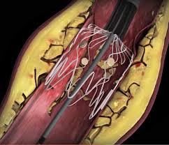 New Technologies To Treat Peripheral Artery Disease Pad Daic