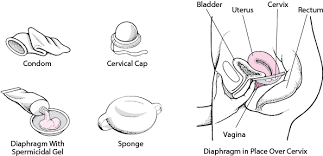 Image result for Cervical Cap
