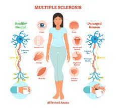 Find updated content daily for sclerosis multiple. What Causes Multiple Sclerosis What We Know Don T Know And Suspect