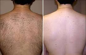 .laser hair removal dublin address: Laser Hair Removal Treatment Bliss Consulting Rooms Rajkot
