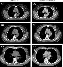 Right now, ct scans are not used routinely to evaluate the breast. Is Contrast Enhancement Required To Visualize A Known Breast Tumor In A Pre Operative Ct Scan Sciencedirect