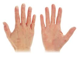 Bayangkan dia punya pedih macam mana. Eczema Psoriasis Leading Skin And Aesthetic Clinic In Malaysia