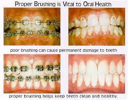 Maybe you would like to learn more about one of these? Pin On Brushing With Braces