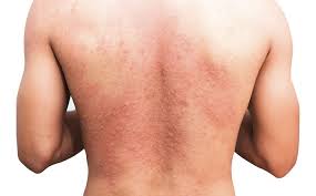 Image result for sweat rash on back