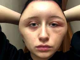 The color is painted on gray strands (to camouflage them), so the dye doesn't sit on your scalp during the coloring process. French Student S Head Swelled From Allergic Reaction To Ppd Hair Dye