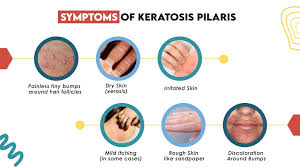 Image result for Keratosis pilaris